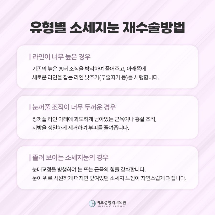 소세지눈재수술 적용 방식 2가지 관련 이미지 3
