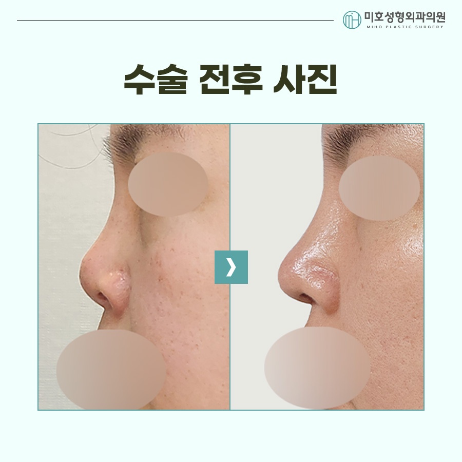 Natural Correction of an Upturned Nose image 7