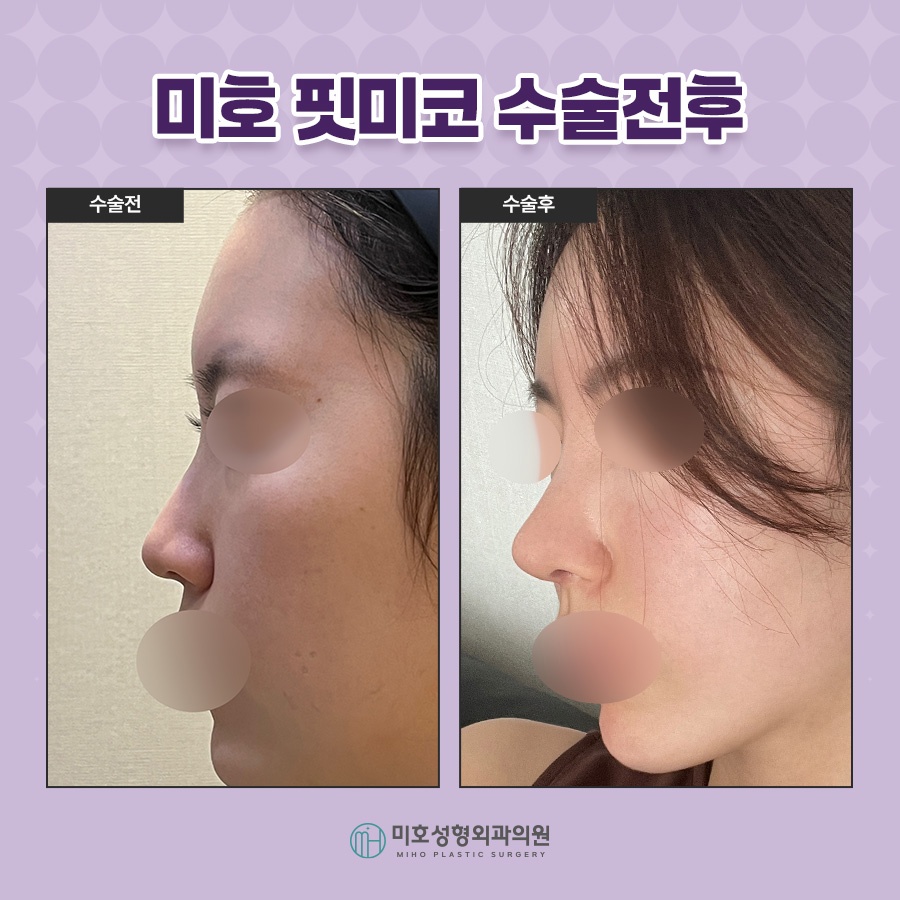 Fit Me Nose, Naturally and Beautifully image 9