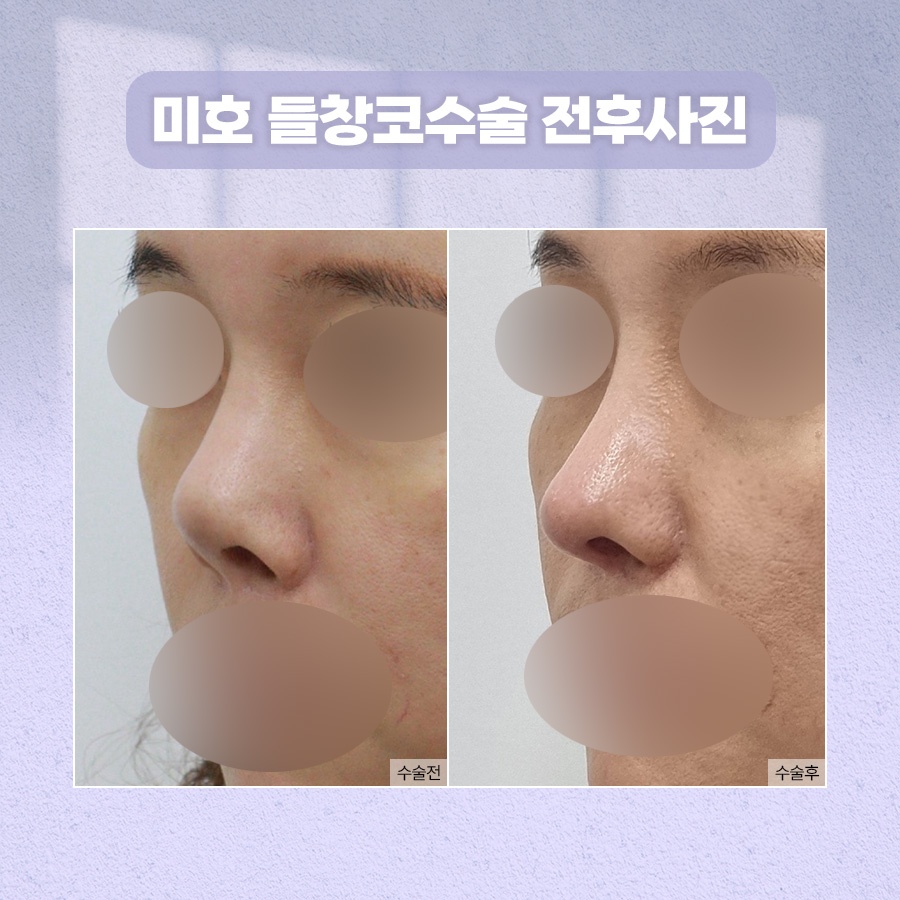 들창코수술 자연스러운 각도 기준 관련 이미지 7