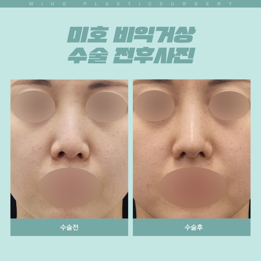 Creating a Naturally Refined Nose with an Alar Lift image 21