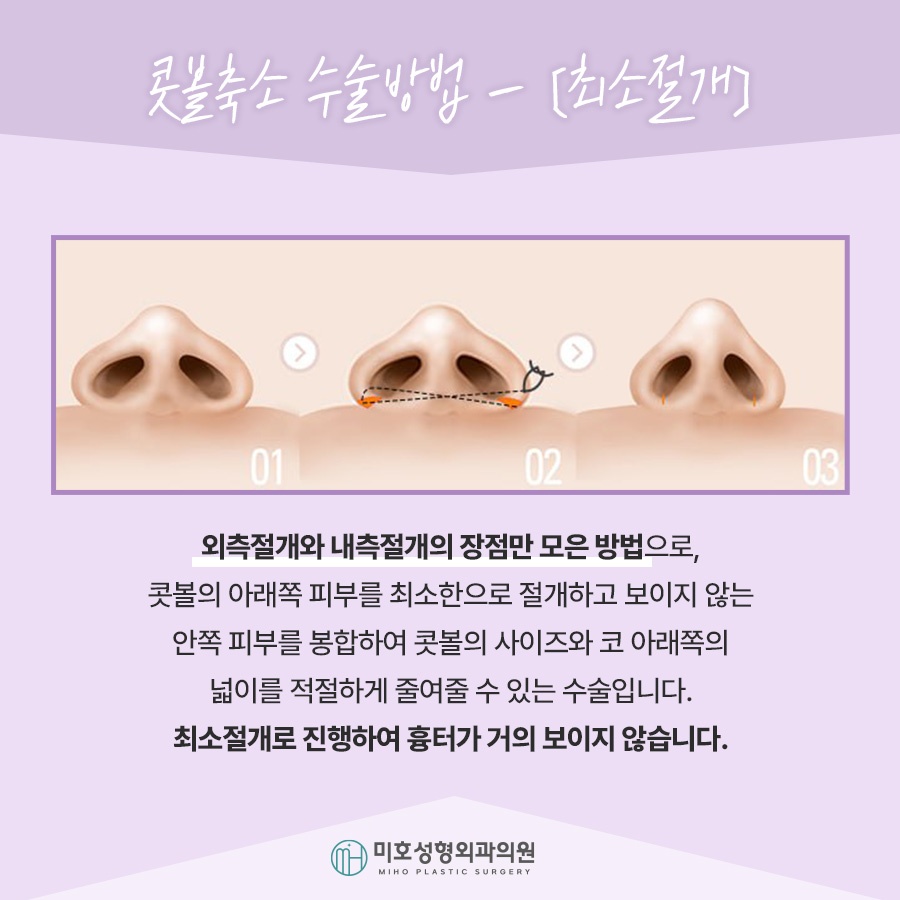 Nasal Alar Reduction in a Natural Direction image 6