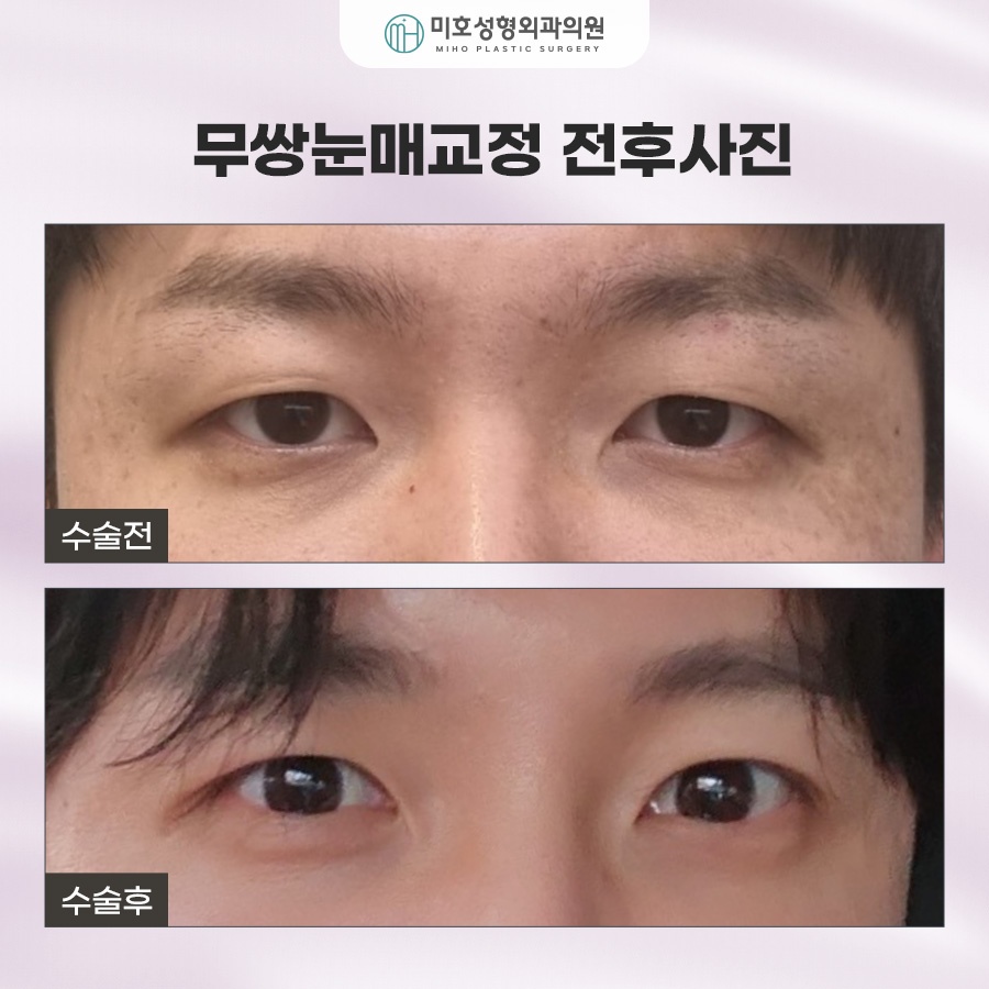 How to Make Your Eyes Bigger Without Double Eyelids: Ptosis Correction for Monolids image 6