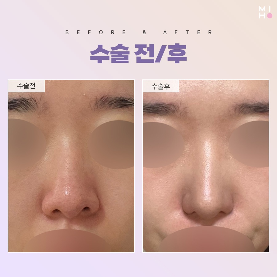 Refining a Bulbous Nose for a Sophisticated Look image 9