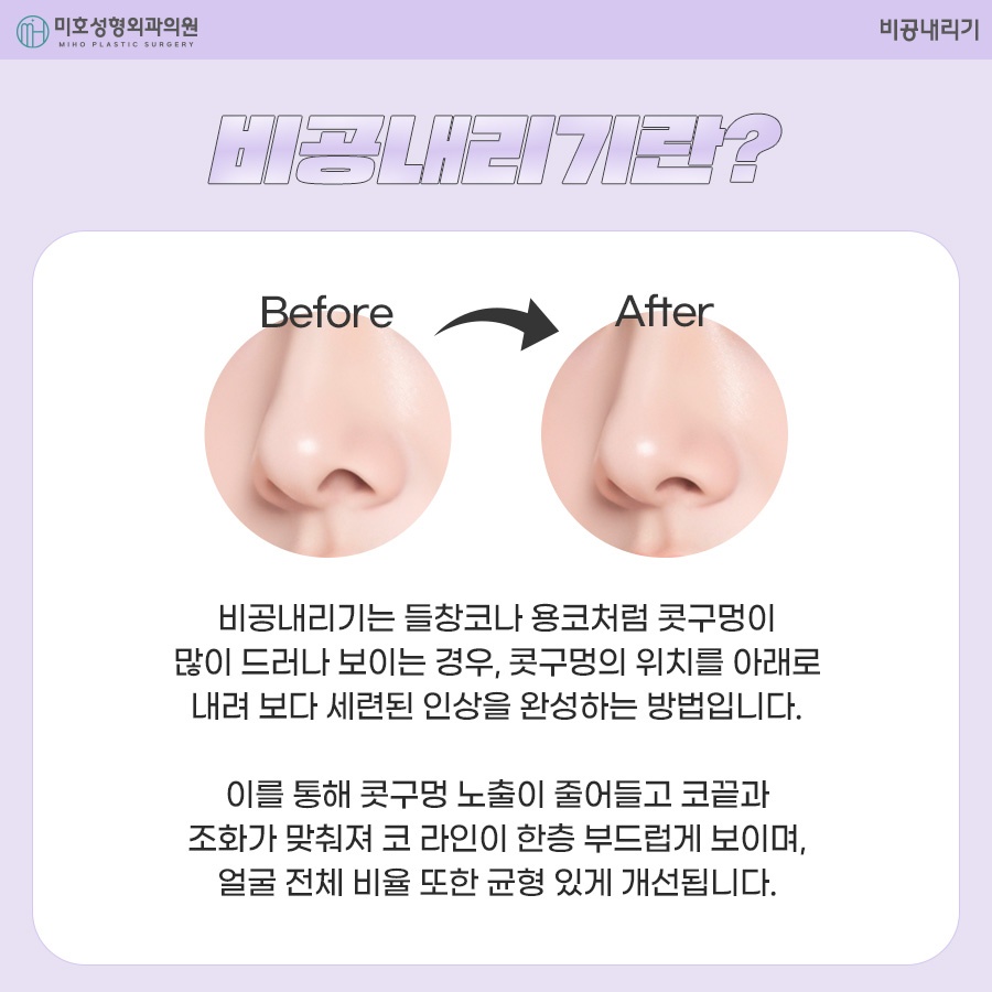 비공내리기 올바른 용코 교정은 관련 이미지 2
