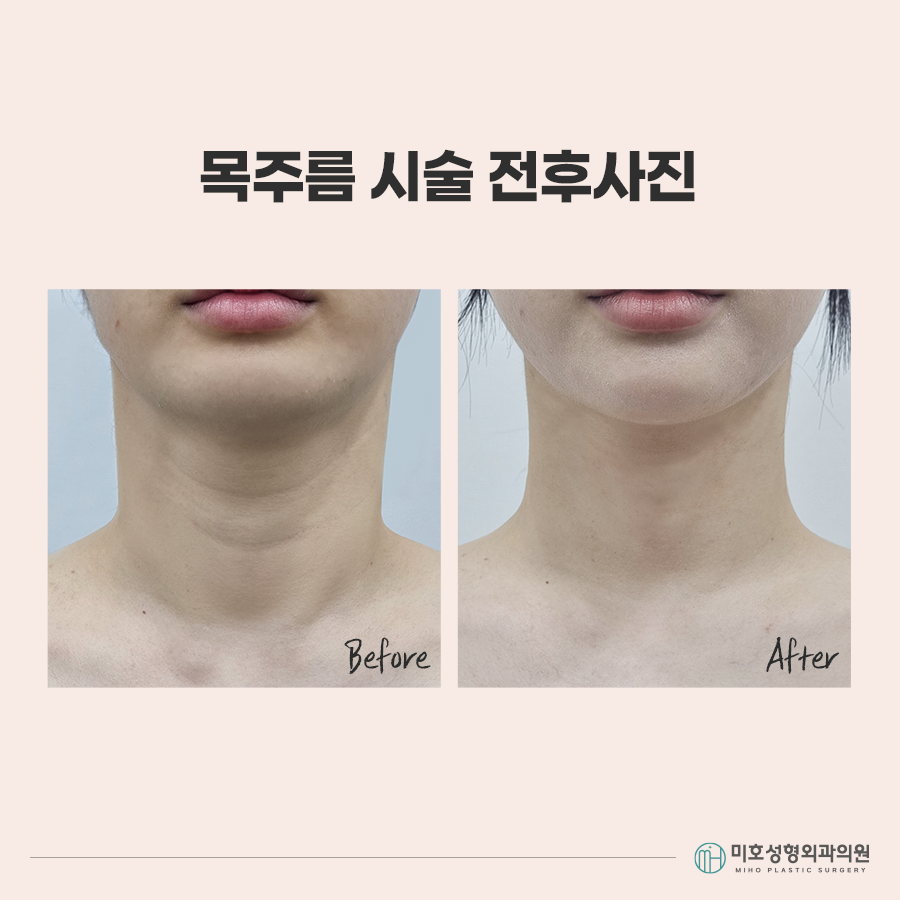 목주름시술 선명한 가로선이 고민이라면 관련 이미지 6
