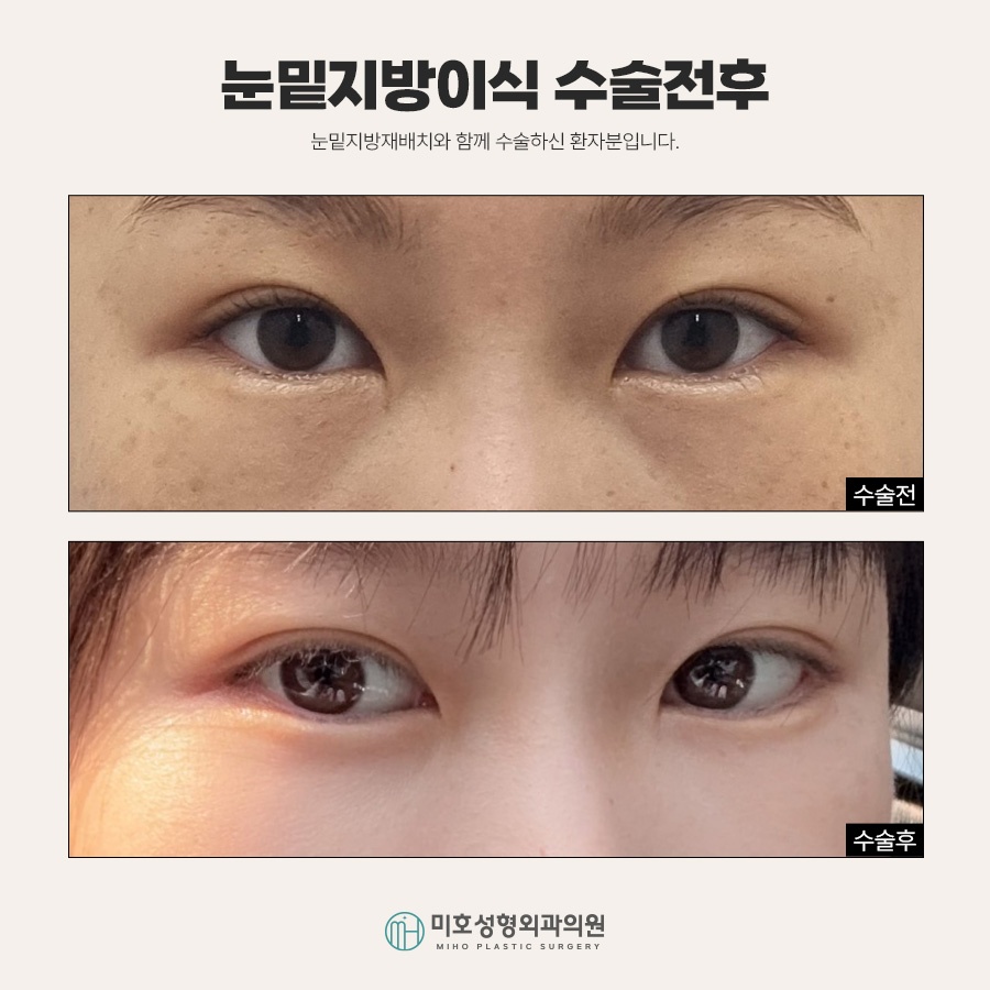 If Under-Eye Fat Grafting Is Stressful Because It Makes You Look Tired image 8