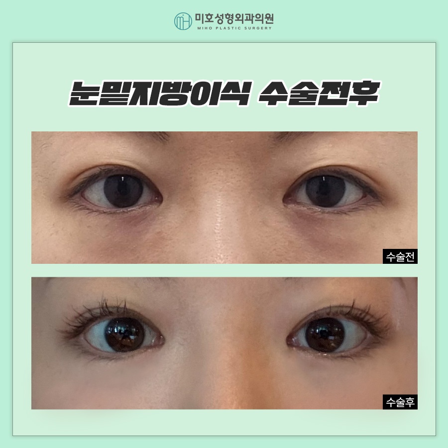 일반 눈밑지방이식과 나노지방이식의 차이점 관련 이미지 8