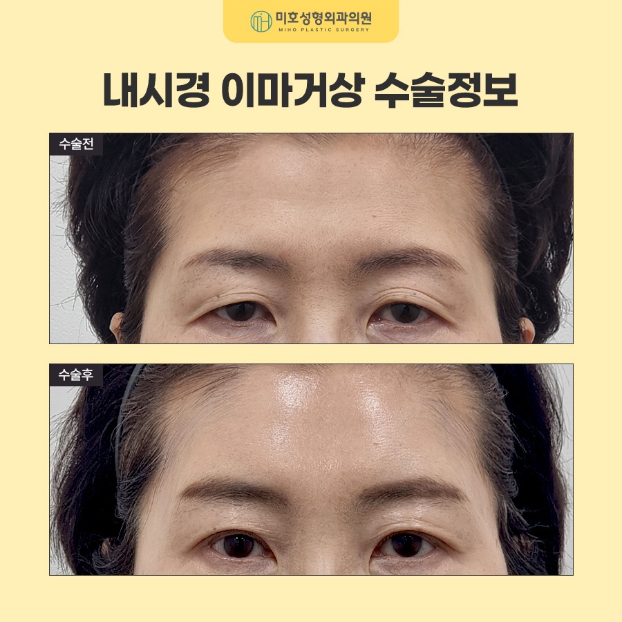 내시경이마거상 부기와 회복기간, 유지기간까지 알아보기 관련 이미지 10
