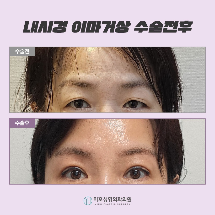 Forehead Lift Surgery Review: Tailored to Sagging Areas image 7