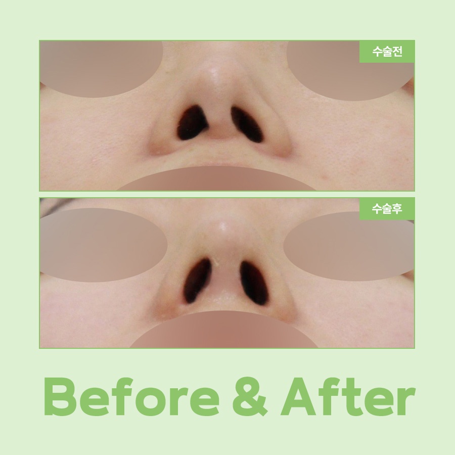 A Complete Guide to the Causes of Uneven Nostrils and the Timing of Revision Rhinoplasty image 9