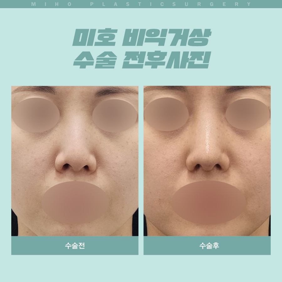 Creating a Naturally Refined Nose with an Alar Lift image 7