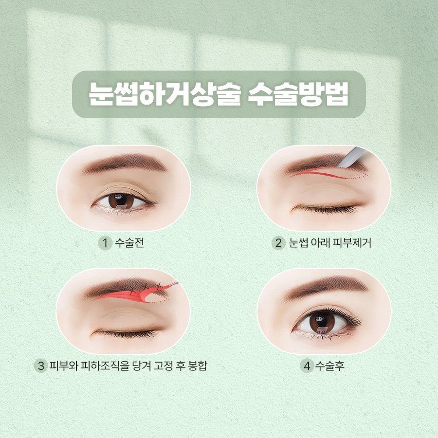 How to Tidy Up Drooping Eyes with Sub-Brow Lift Surgery image 5
