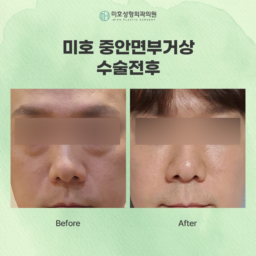 중안면거상 노화 증상에 주목하여 관련 이미지 9