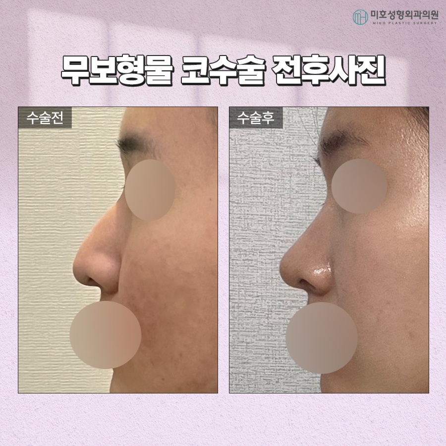 Criteria for Choosing Natural-Looking Implant-Free Rhinoplasty image 8