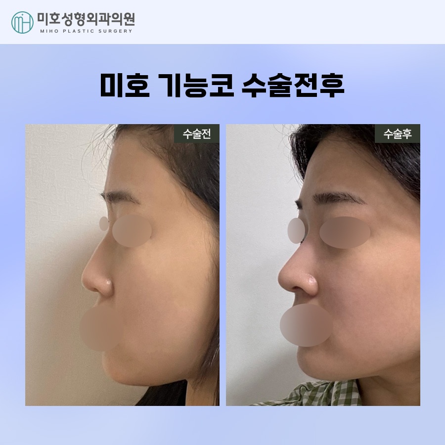 If You Are Looking for Ways to Improve Septal Deviation and Rhinitis Surgery image 10