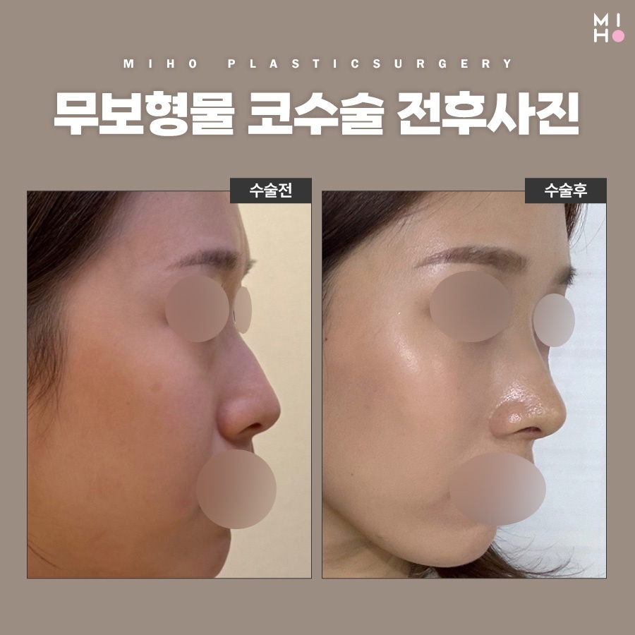 무보형물코수술 부담 없는 모양 개선 관련 이미지 11