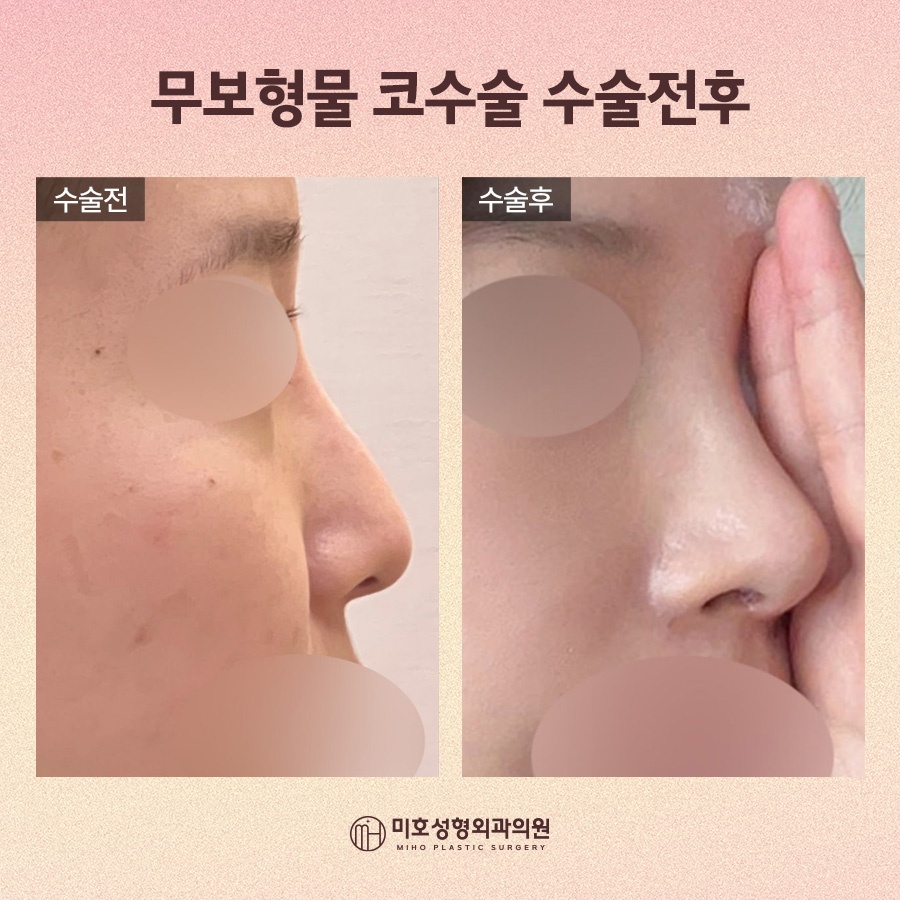 무보형물코수술 자연스레 보완하려면 관련 이미지 8