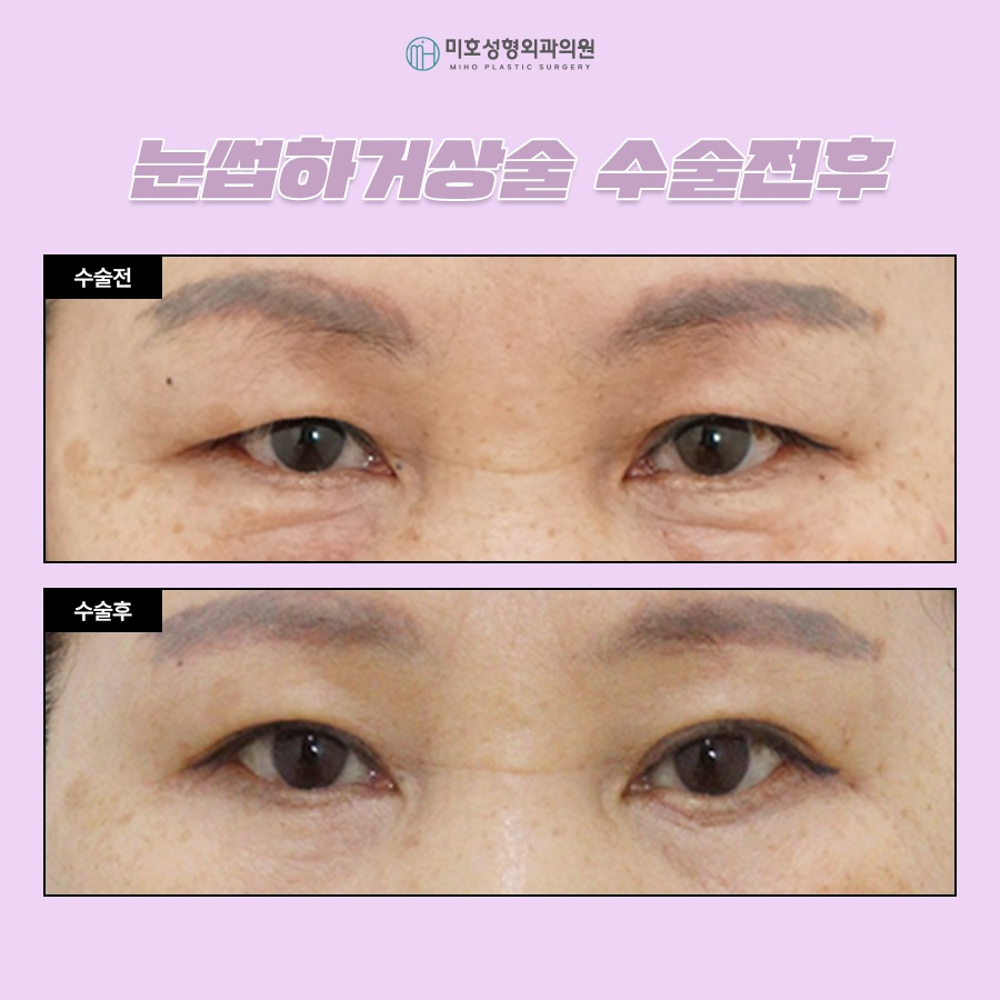 눈썹하거상술 비용과 후기 흉터 궁금하다면 관련 이미지 9