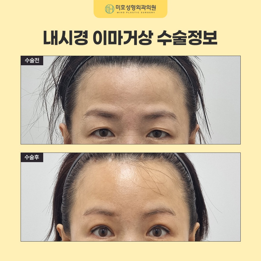 내시경이마거상 부기와 회복기간, 유지기간까지 알아보기 관련 이미지 7