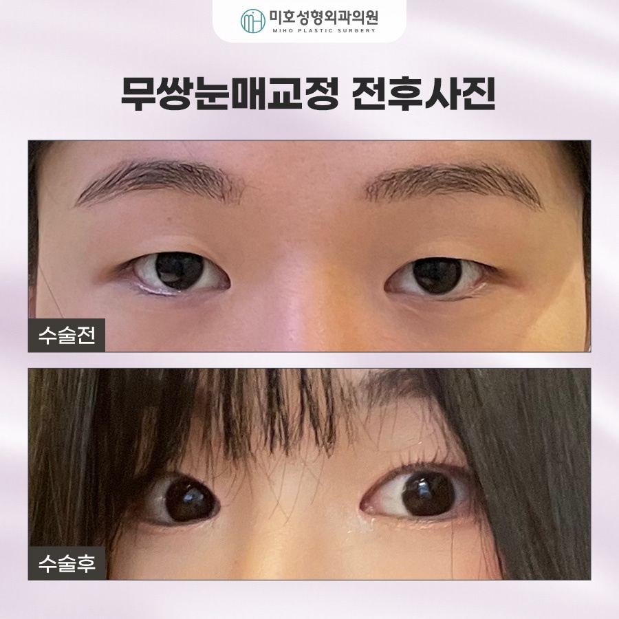 How to Make Your Eyes Bigger Without Double Eyelids: Ptosis Correction for Monolids image 8