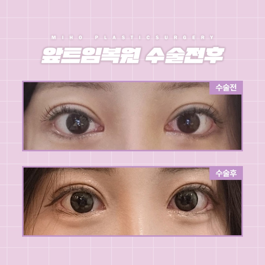 앞트임복원 새롭게 자리 잡도록 관련 이미지 6