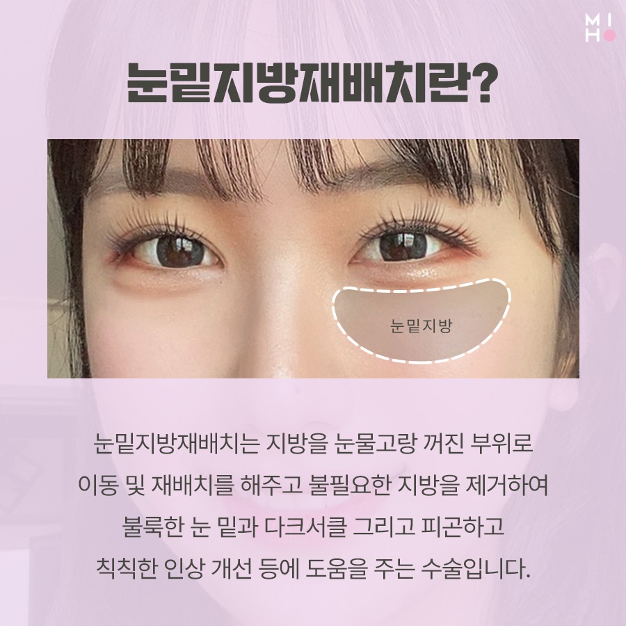 눈밑지방재배치 보완할 곳을 파악하여 관련 이미지 2