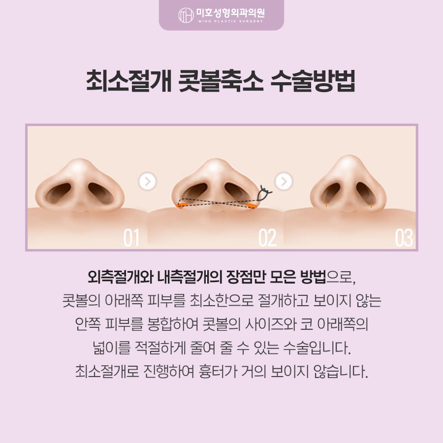 콧볼축소 고려 유형과 방식 관련 이미지 6