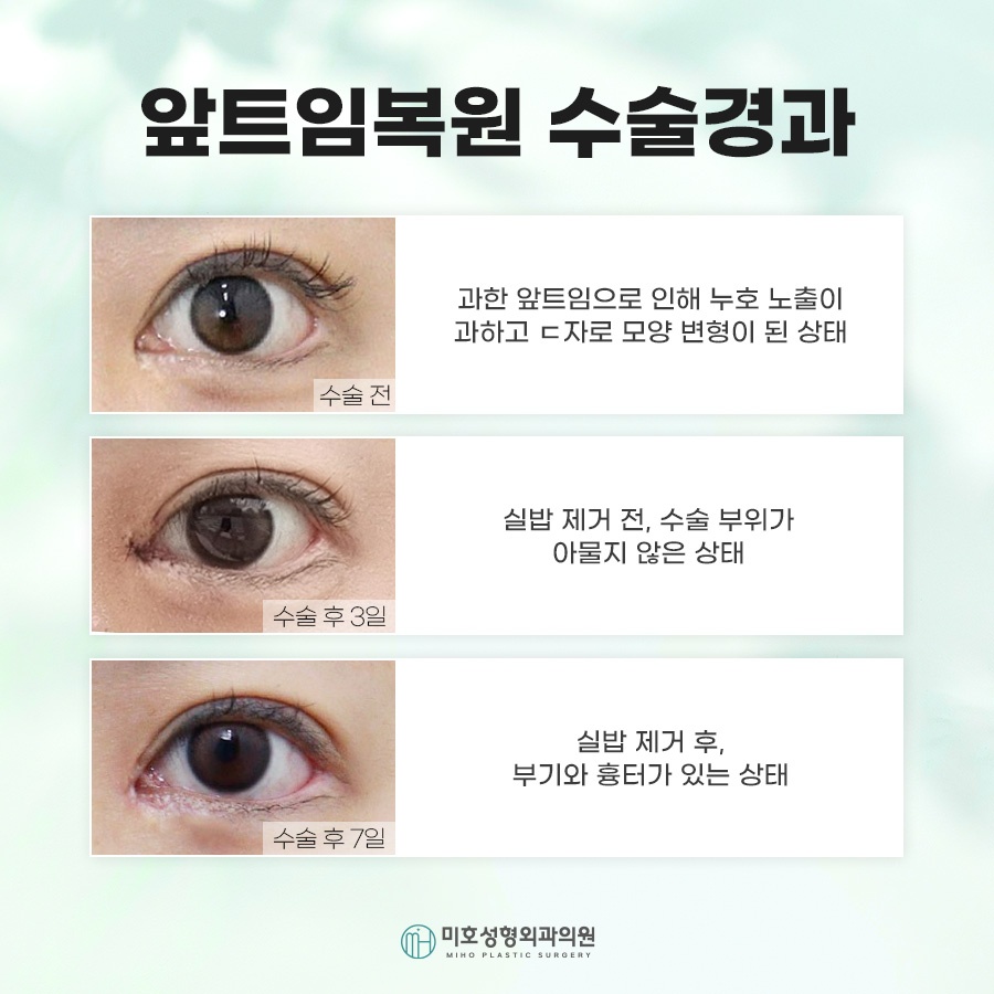 How Medial Canthoplasty Restoration Is Performed and Scar Care image 5
