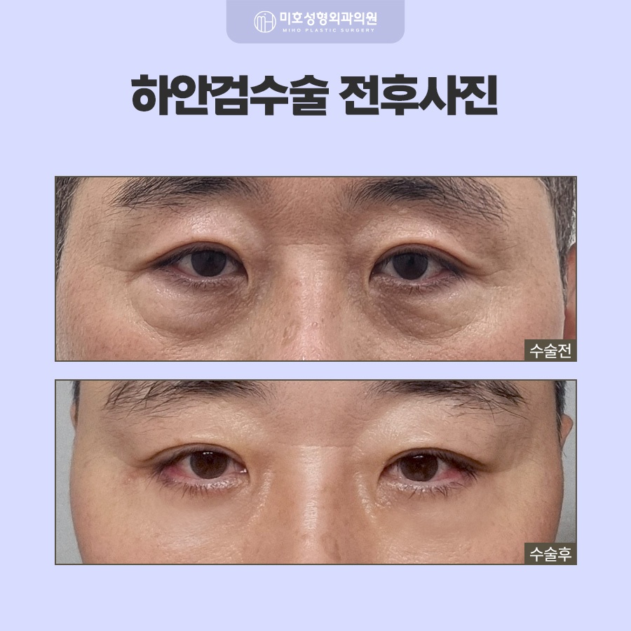 하안검수술 아래쪽 변화가 고민이라면 관련 이미지 9
