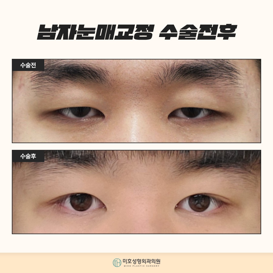 남자눈매교정 자연스러운 이미지로 관련 이미지 9