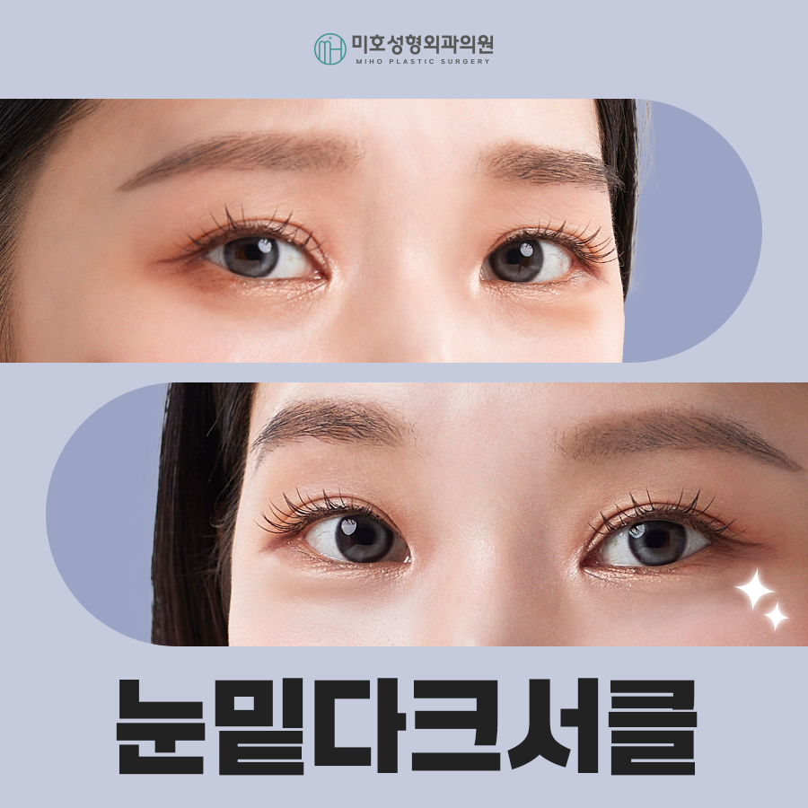 Improving Dark Circles Under the Eyes with Under-Eye Fat Repositioning to Create a More Vibrant Eye Area image 1
