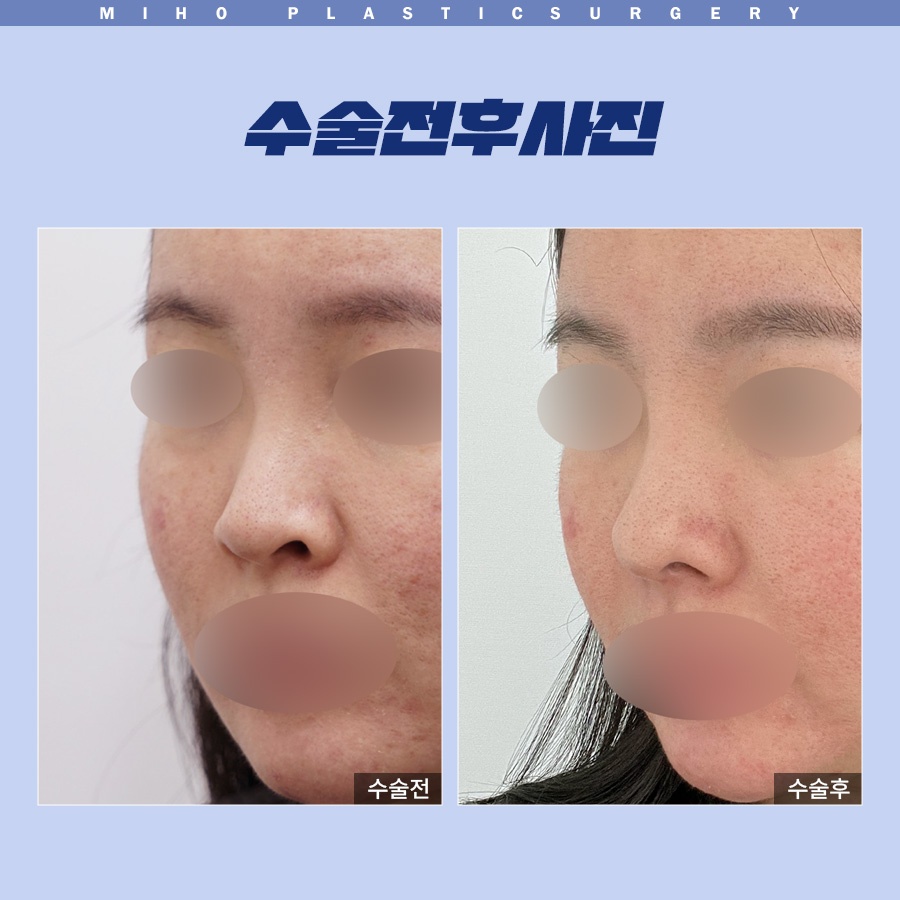 Correcting a Dragon Nose with Nostril-Lowering Surgery image 9