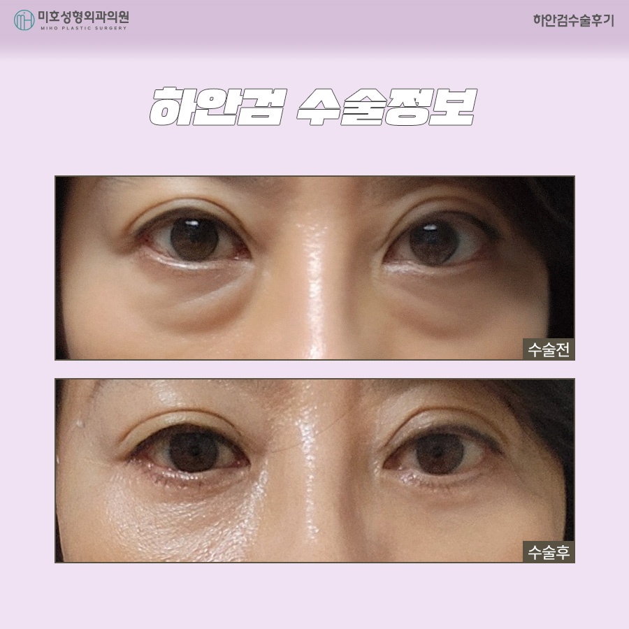 하안검수술후기 주인공이 되는 법 관련 이미지 8