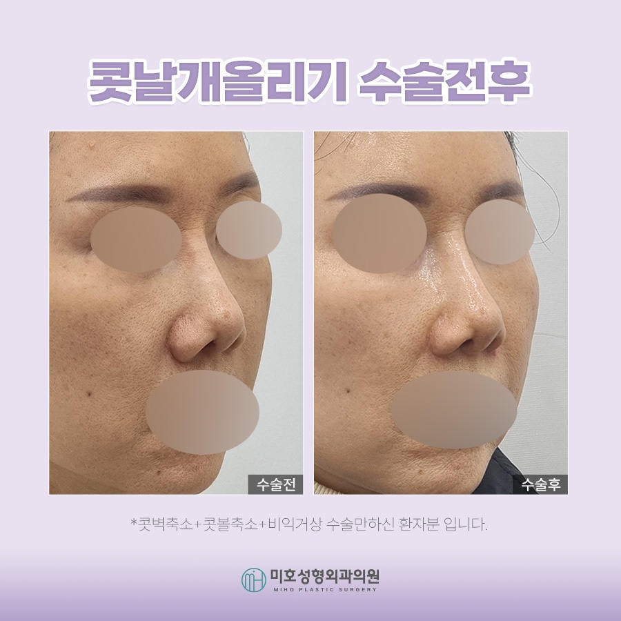 콧날개올리기 개개인에게 맞는 방식으로 관련 이미지 7