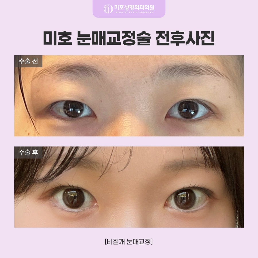 눈매교정술 힘 조절이 필요하다면 관련 이미지 8