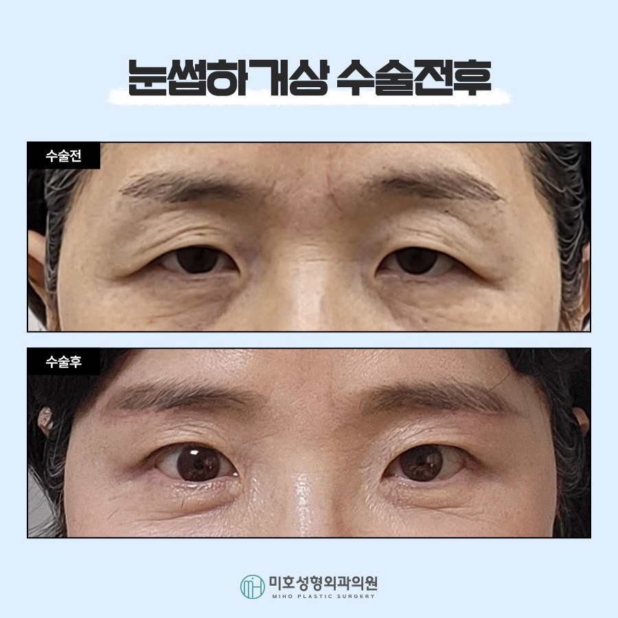 눈썹하거상 노안형 얼굴에 변화를 주려면 관련 이미지 8