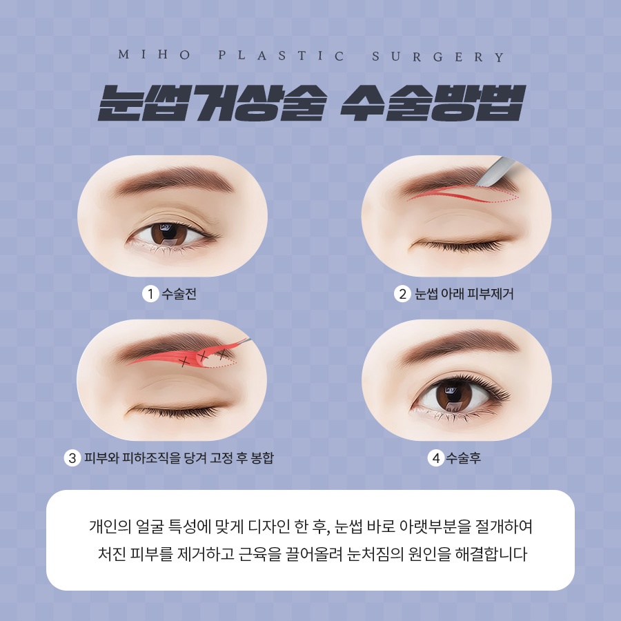 눈썹거상술 잘못된 오해와 장단점 관련 이미지 4