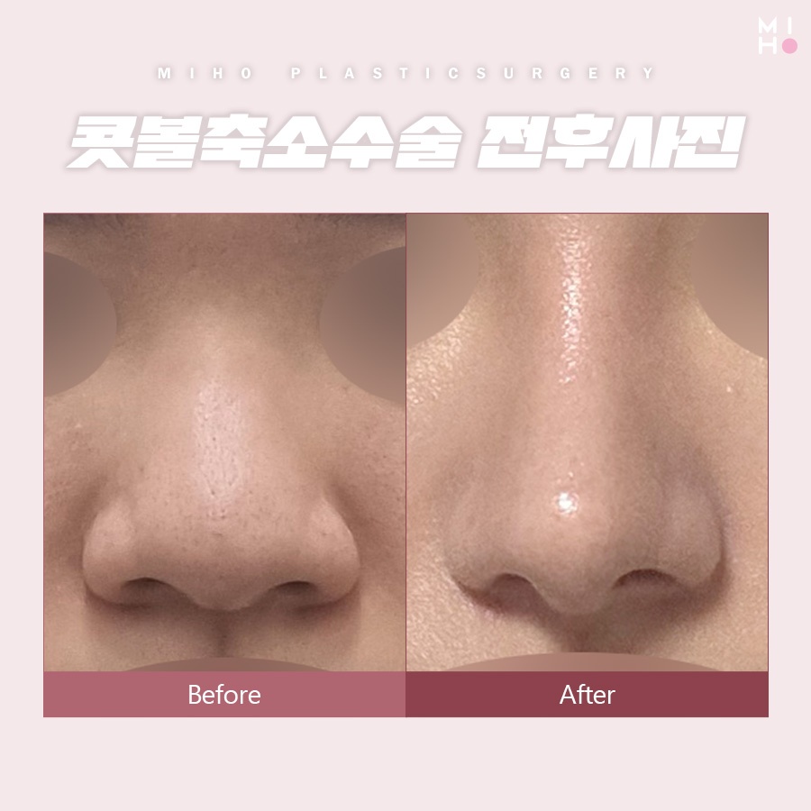 콧볼축소수술 나에게 적합한 방식으로 관련 이미지 6