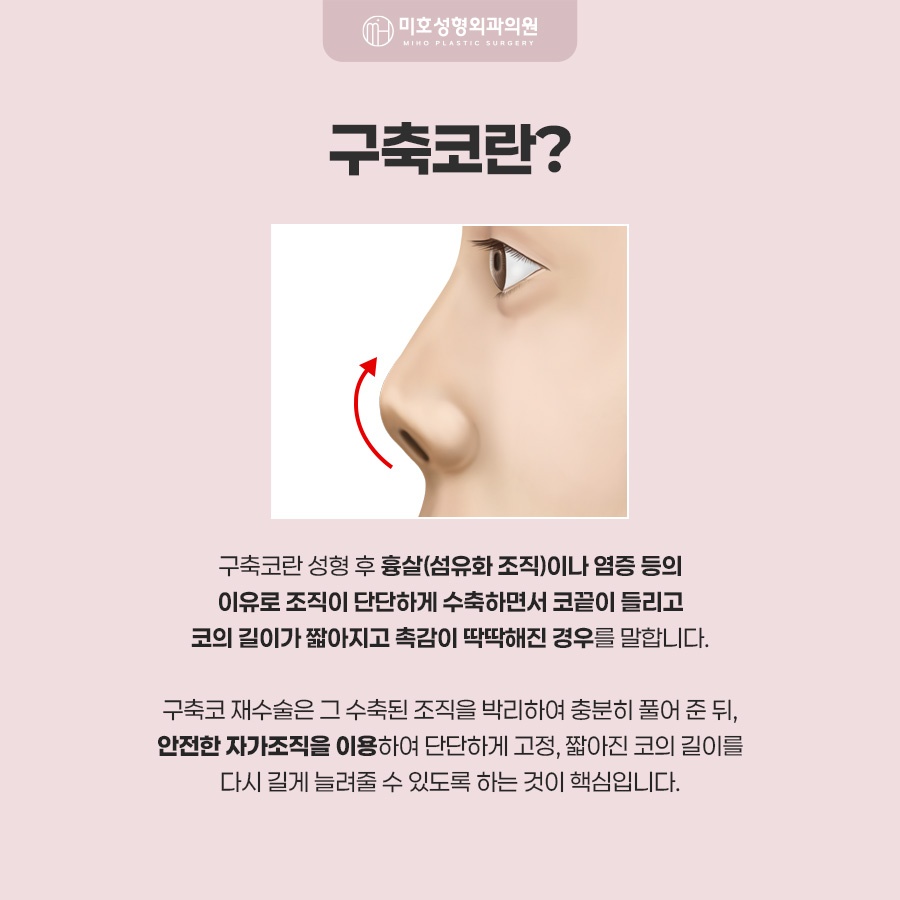 구축코재수술 코끝이 들리고 짧아졌다면 확인해야 할 것 관련 이미지 2