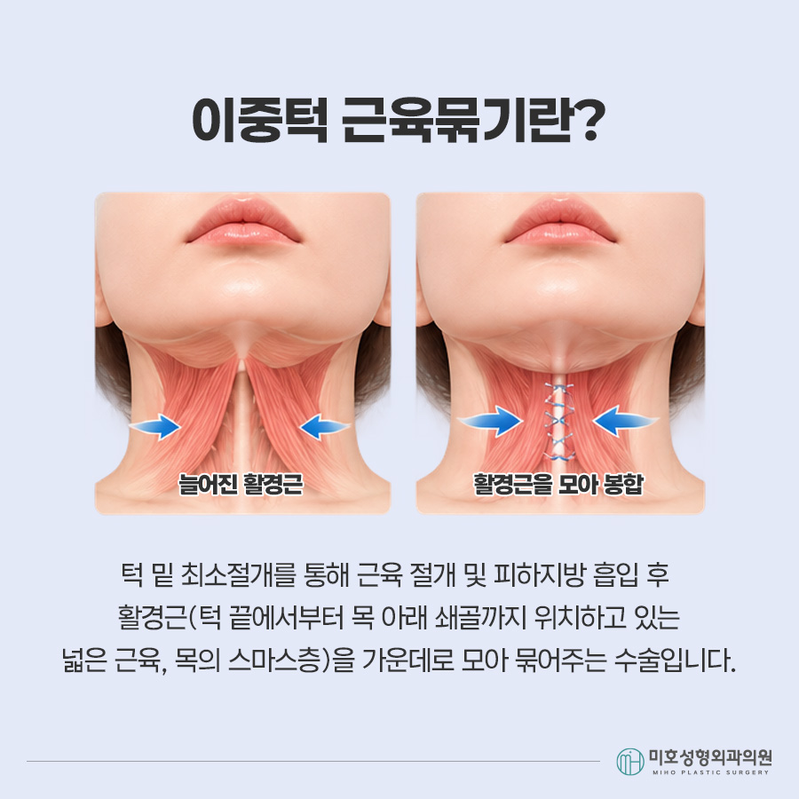 이중턱묶기란? 지방흡입과 차이부터 적합한 경우, 회복 과정까지 관련 이미지 3
