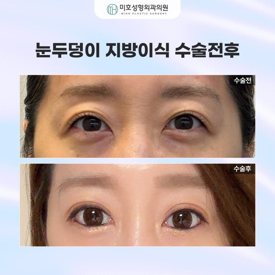Upper Eyelid Fat Grafting to Improve Hollow Eyes and Make Them Look More Lively image 8