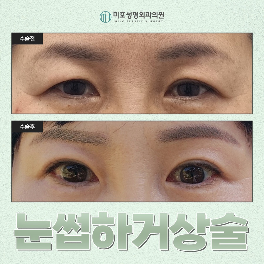How to Tidy Up Drooping Eyes with Sub-Brow Lift Surgery image 1