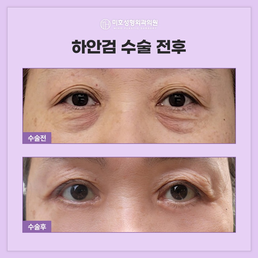 When Is Lateral Canthal Fixation Needed with Lower Blepharoplasty? image 6