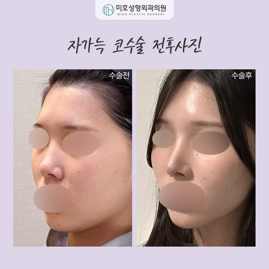 For a Natural-Looking Result with Costal Cartilage Nose Surgery image 9