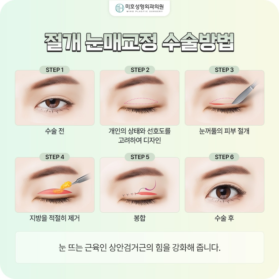 남자눈매교정 졸려 보이는 인상이 고민이라면 관련 이미지 5