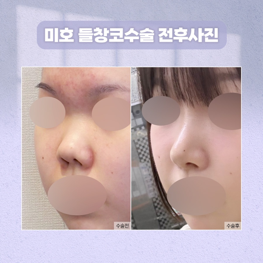 들창코수술 자연스러운 각도 기준 관련 이미지 6