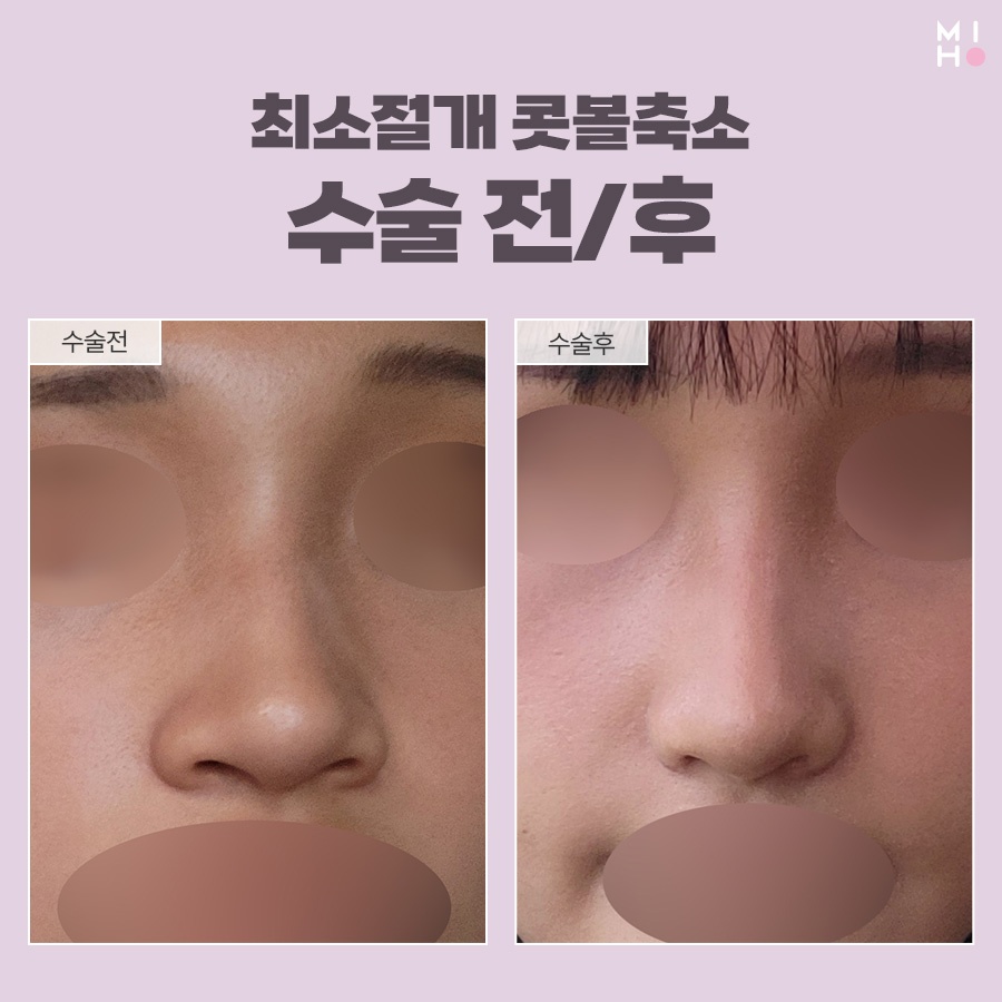 최소절개콧볼축소 부담을 줄이며 세련되게 관련 이미지 8