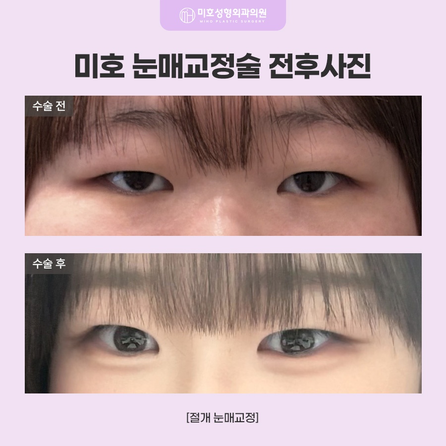 눈매교정술 힘 조절이 필요하다면 관련 이미지 7
