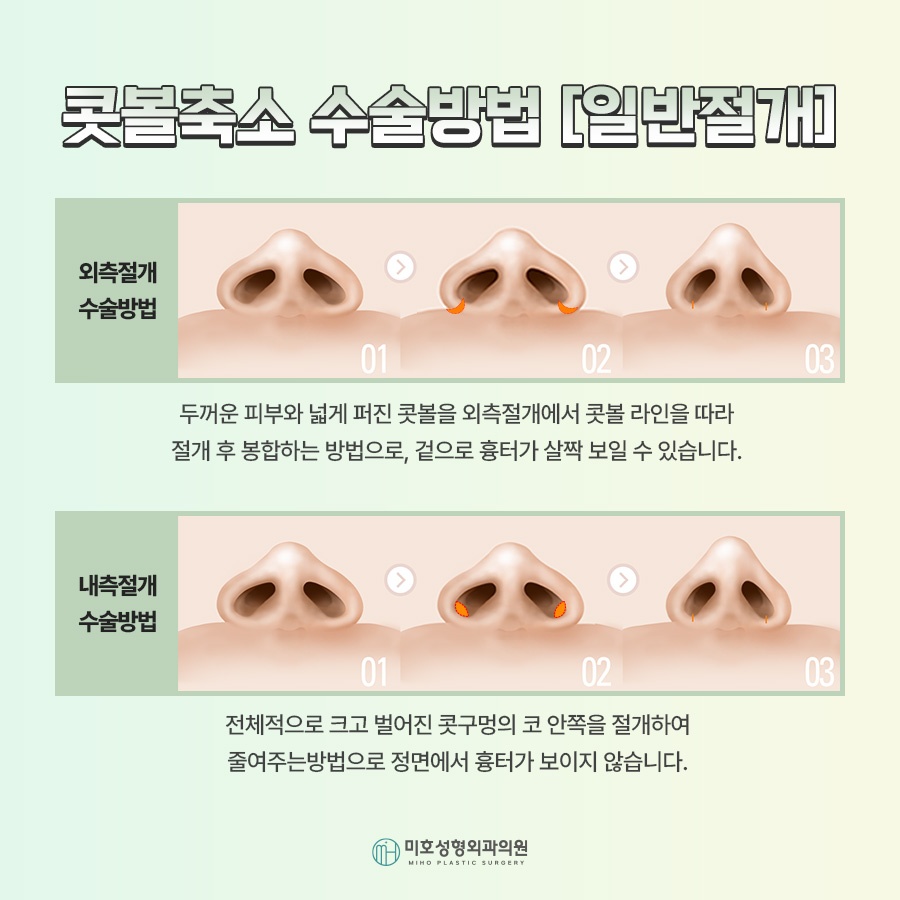 A Successful Guide to Male Alar Reduction for a Refined Appearance image 5
